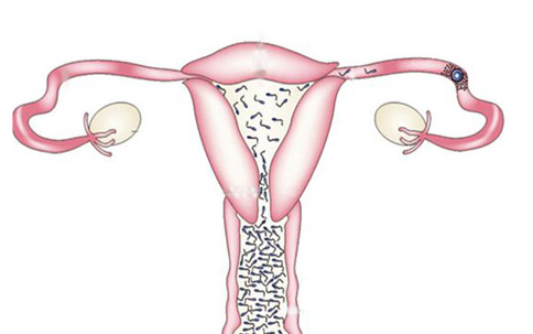 慢性输卵管炎的危害有哪些?