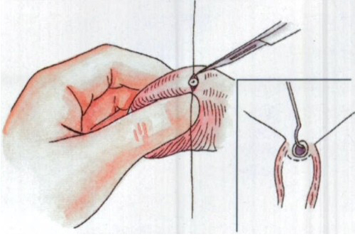 男性结扎的好处和坏处,在这里一一列举