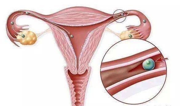 输卵管粘连能不能自然怀孕