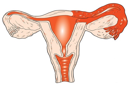 输卵管堵塞的预防要从哪些方面入手