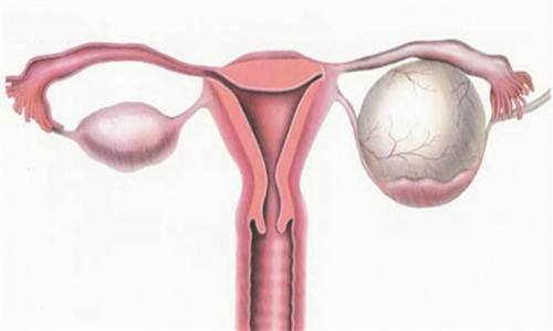 卵巢囊肿的初期症状表现是什么