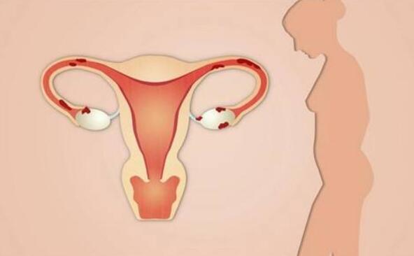输卵管堵塞的不同程度病变