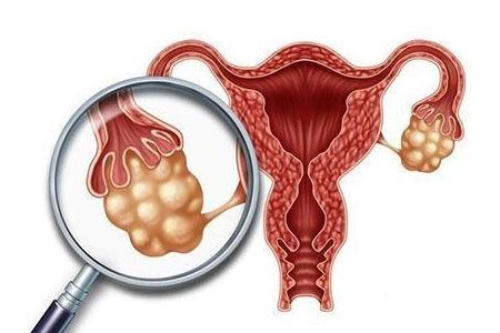 多囊卵巢综合征的调理方法有哪些？
