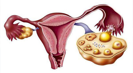 治疗多囊卵巢时要知道的注意事项