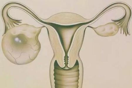 多囊卵巢的话，B超能检查出来吗?