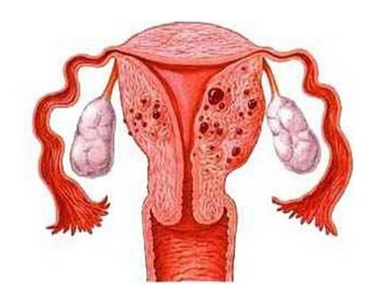 子宫腺肌症会出现什么症状?