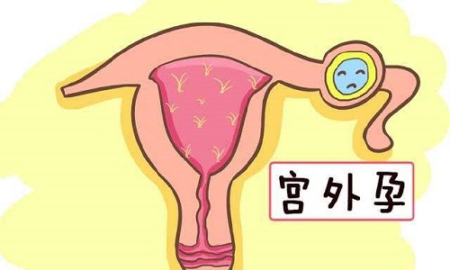 输卵管堵塞是否会致宫外孕