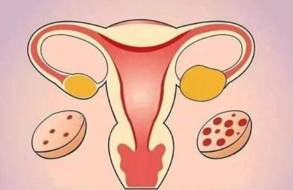 治疗多囊卵巢综合征的常规方法有哪些?