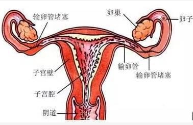 女性输卵管为什么堵塞？