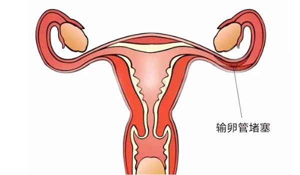 女性输卵管造影后注意事项？