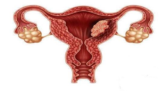 子宫腺肌症与避孕药的关系