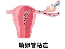 女性输卵管粘连有哪几种情况?