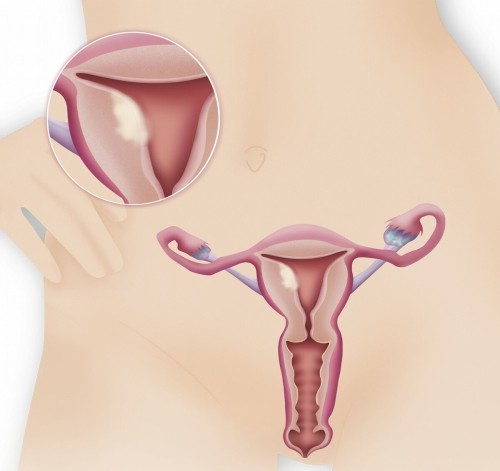 子宫肌瘤影响怀孕吗？