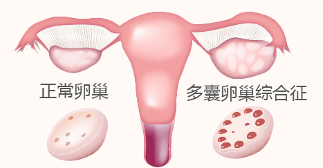 多囊卵巢除了治疗还能做什么?