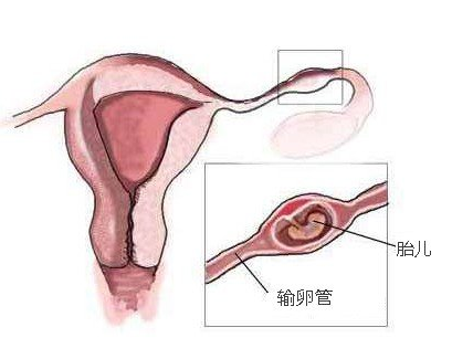 输卵管堵塞是否会影响女性正常排卵？
