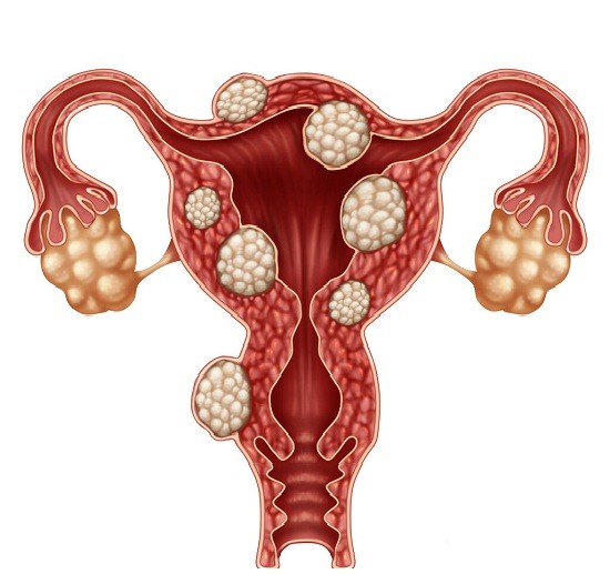 多囊卵巢治疗外还能做什么有益于的事?