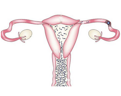 左侧输卵管堵塞如何能够快速怀孕？