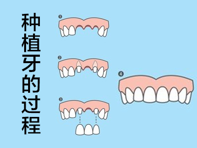 天津种植牙齿的全过程_中诺专业医生_可放心治疗