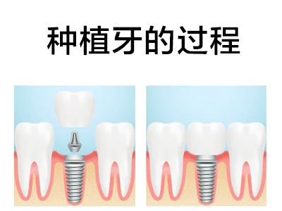 天津全口种植牙齿手术过程图片