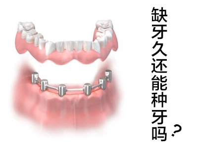 天津半口种植牙图片牙齿图片，种植牙恢复期要注意什么?