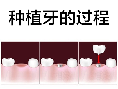 天津全口种植牙动画视频全过程-种植牙步骤