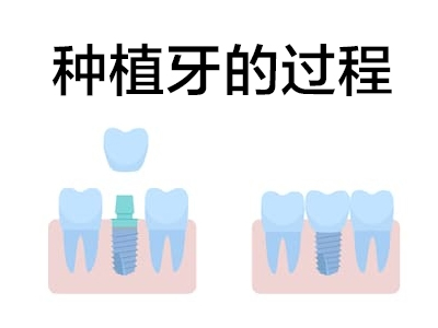 天津半口种植牙一般要多长时间，种植牙的手术疼吗