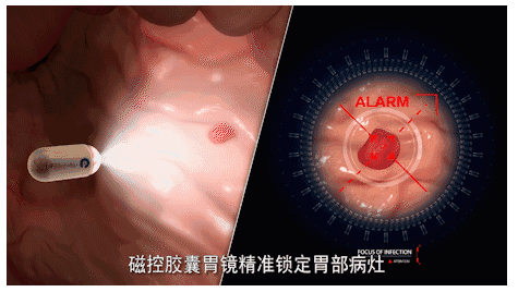 南宁东大中医肛肠医院磁控胶囊胃镜机器人，解决做胃镜三难问题