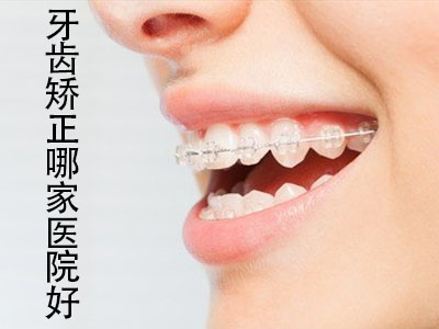 天津陶瓷牙齿矫正器图片_陶瓷牙齿矫正_牙齿矫正器带多久
