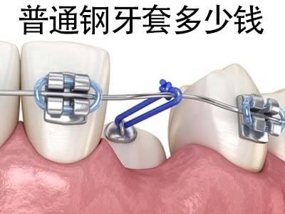 牙齿正畸-天津牙齿正畸矫正后还要戴保持器吗，保持器有什么作用