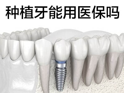 天津全口种植牙补贴政策-种植牙能用医保吗？
