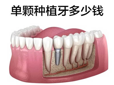 天津全口种植牙多少钱一颗2021-智齿种植牙