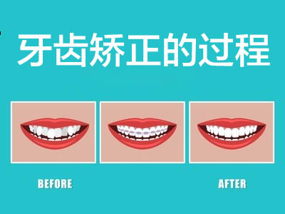 天津牙齿正畸图片-矫正牙齿的过程