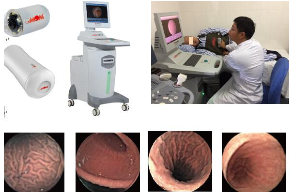 胃部不适来南宁东大医院做磁控电子胶囊胃镜检查可靠吗?