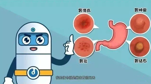 南宁东大医院引进的磁控胶囊胃镜机器人能够帮大家解决胃镜三难题