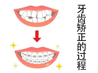 天津牙齿正畸戴牙套的过程-牙齿正畸过程