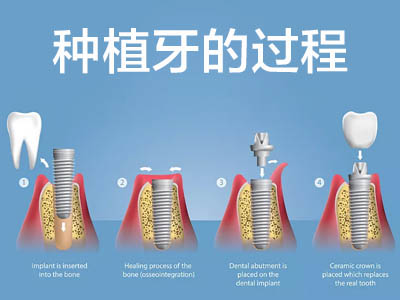 天津全口种植牙需要去几次医院  流程