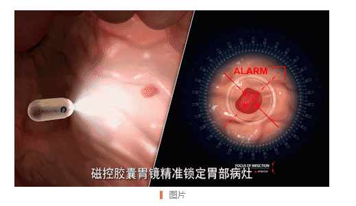医生解释：胃部不舒服来南宁东大医院做磁控电子胶囊胃镜检查安全吗?