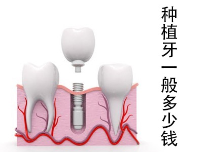 天津全口种植牙骨粉价格-种植牙植骨多少钱？