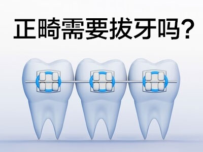 天津牙齿正畸一定要拔牙-拔牙矫正牙齿效果好吗？