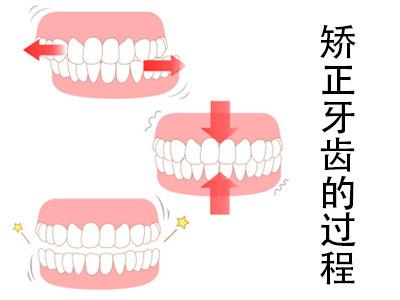 天津成人牙齿正畸照片_成人矫正_牙齿过程