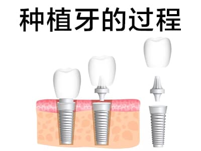 天津前牙种植即刻修复视频-即拔即种种植牙过程