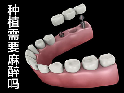 天津全口种植牙齿手术痛不痛，需要住院吗