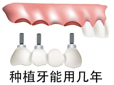 天津全口半口种植牙的牙根能使用多少年