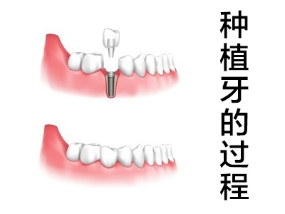 天津全口种植牙流程图及时间，全口种植牙修复步骤