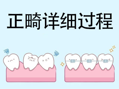 天津牙齿正畸的步骤和时间 牙齿矫正要多久