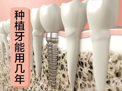 天津全口种植牙植骨手术要多久才恢复