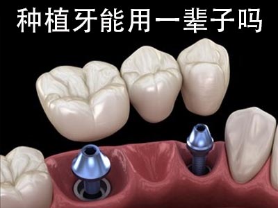 天津种植牙的寿命是几年--能用一辈子吗