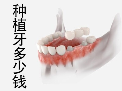 天津医院种牙多少钱合适 种植牙多少钱