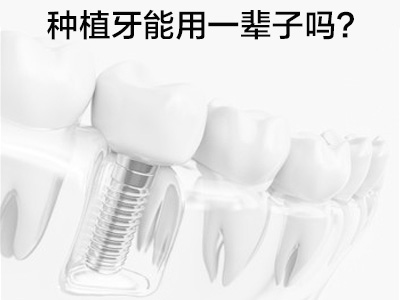 天津半口种植牙能用多久 种植牙的寿命有多长