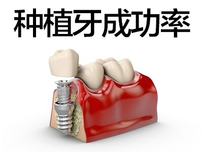 天津全口种植牙有效吗来中诺就诊有保障